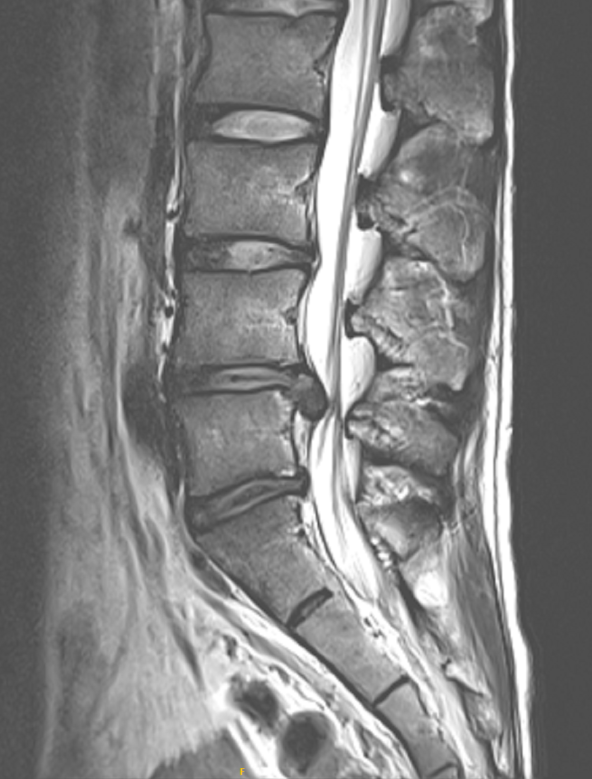 허리디스크 MRI
